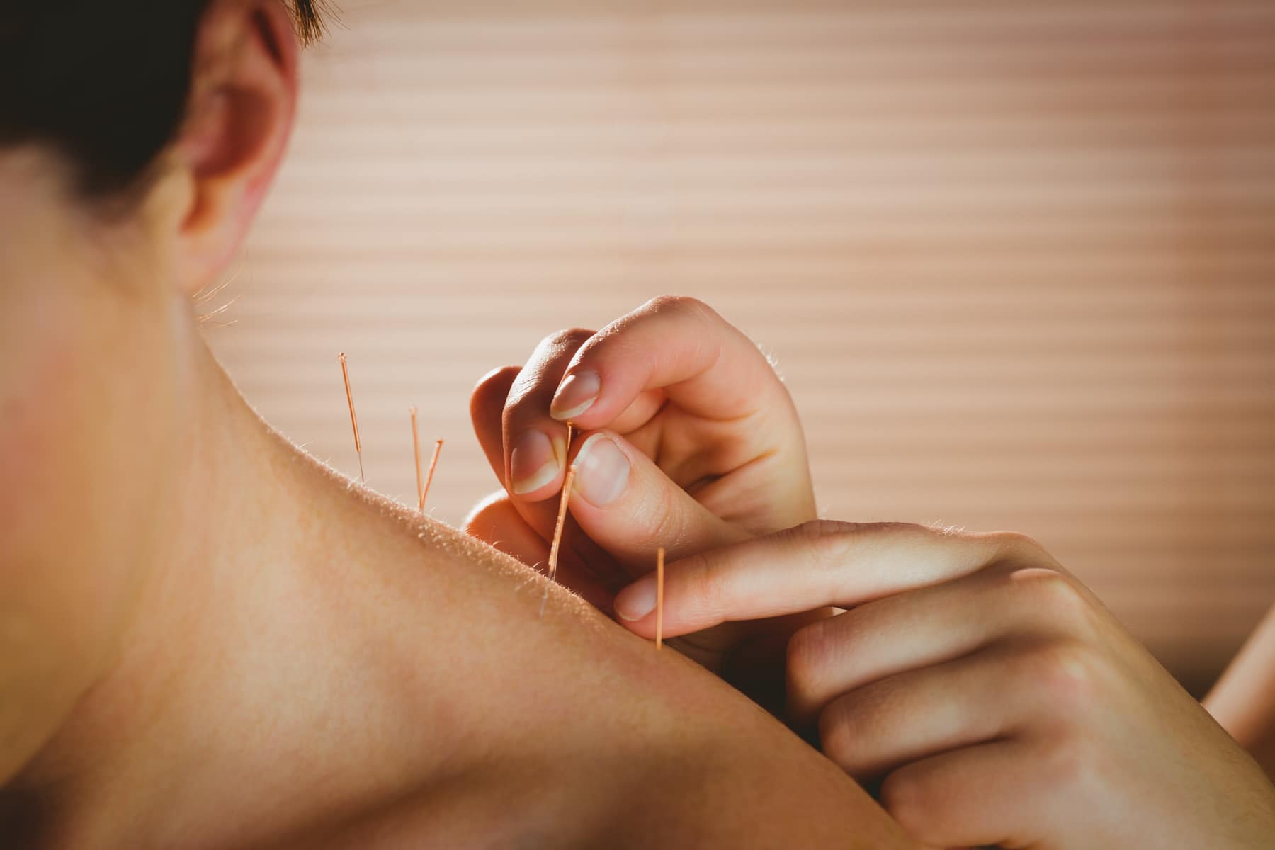 Acupuncture and TCM​ - Young woman getting acupuncture treatment in therapy room